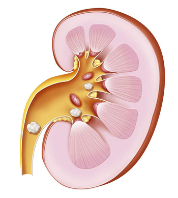 肾结石的常见症状有哪些？重庆康华医院治疗肾结石