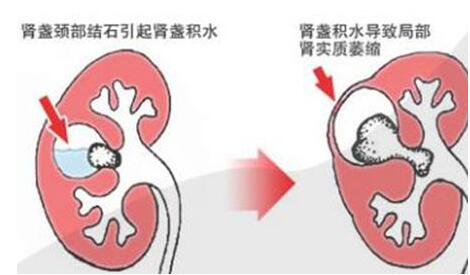 重庆肾结石医院,重庆康华医院,肾结石检查,肾结石治疗