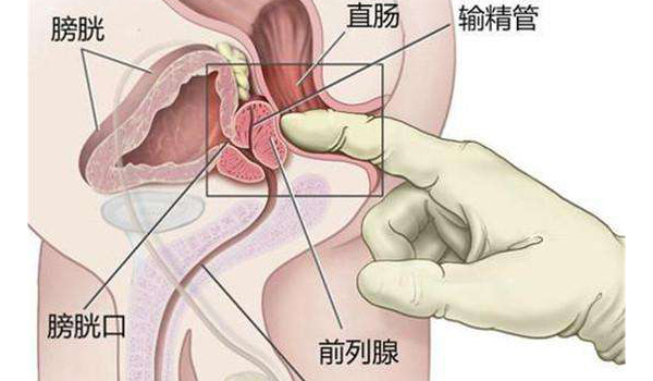 前列腺增生,重庆康华医院,前列腺等离子电切术