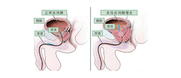 前列腺增生,重庆康华医院,前列腺等离子电切术