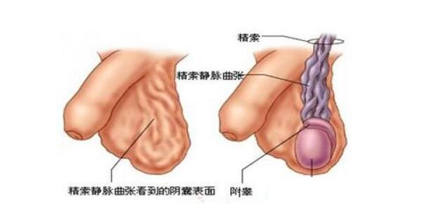 精索静脉曲张,重庆康华医院,显微镜下精索静脉结扎术