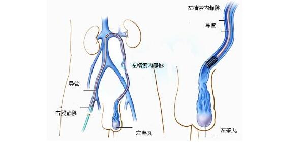 精索静脉曲张,重庆康华医院,显微镜下精索静脉结扎术