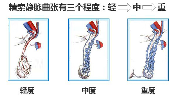 精索静脉曲张,重庆康华医院,显微镜下精索静脉结扎术