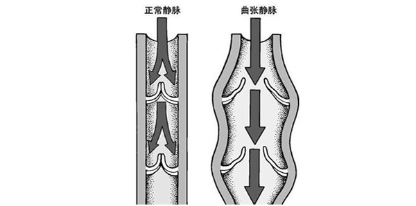 精索静脉曲张,重庆康华医院,显微镜下精索静脉结扎术