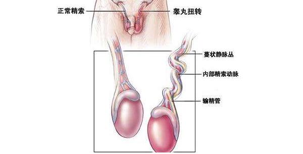 鞘膜积液,重庆康华医院,鞘膜积液的治疗