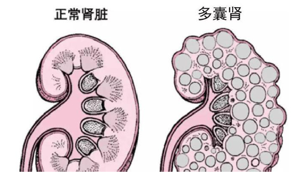 肾囊肿,重庆康华医院,肾囊肿的治疗