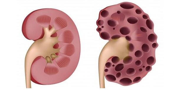 肾囊肿,重庆康华医院,肾囊肿的治疗