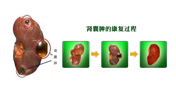 肾囊肿,重庆康华医院,肾囊肿的治疗