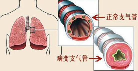 慢性支气管炎的防治,重庆康华医院内科