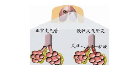 慢性支气管炎的防治,重庆康华医院内科