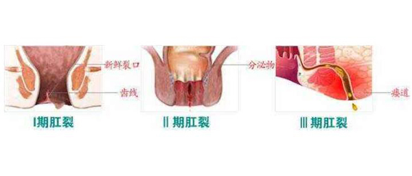 肛裂的治疗,重庆康华医院肛肠外科