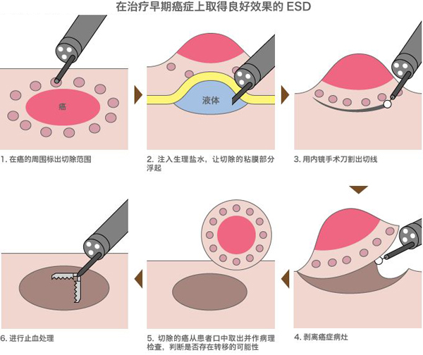 早期胃癌的筛查与治疗,重庆康华医院消化内科