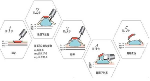 早期胃癌的筛查与治疗,重庆康华医院消化内科