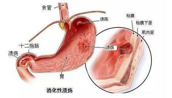 消化性溃疡的诊断与治疗,重庆康华医院消化内科