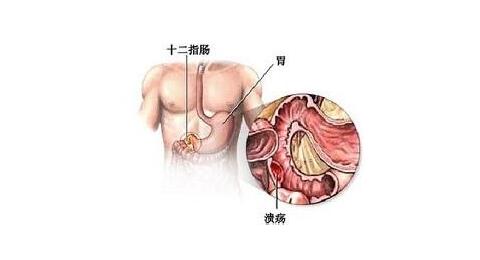 消化性溃疡的诊断与治疗,重庆康华医院消化内科