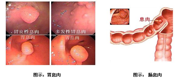 胃肠息肉的诊断与治疗,重庆康华医院消化内科