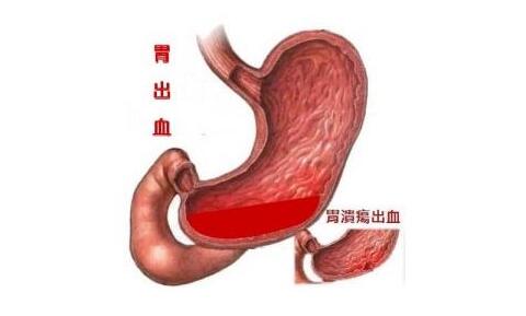 消化道出血的诊断与治疗,重庆康华医院消化内科