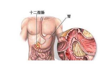 消化道出血的诊断与治疗,重庆康华医院消化内科