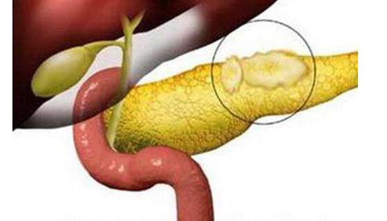 急性胰腺炎的诊断与治疗,重庆康华医院消化内科