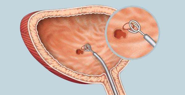 膀胱癌的诊断与治疗,重庆康华医院泌尿外科
