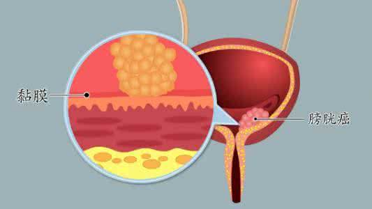 膀胱癌的诊断与治疗,重庆康华医院泌尿外科