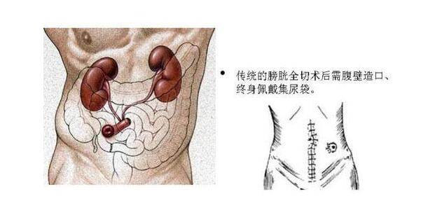 膀胱癌的诊断与治疗,重庆康华医院泌尿外科