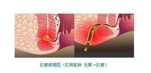 肛瘘的治疗,重庆康华医院肛肠外科