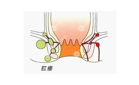 肛瘘的治疗,重庆康华医院肛肠外科