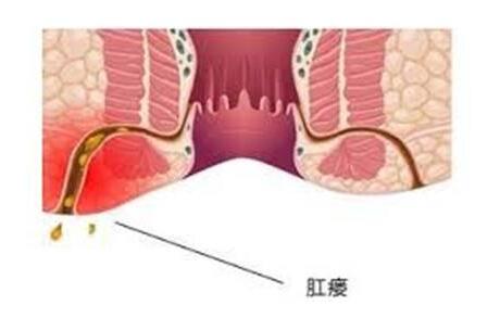 肛瘘的治疗,重庆康华医院肛肠外科