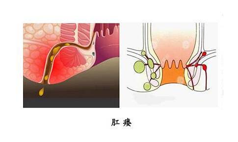 肛瘘的治疗,重庆康华医院肛肠外科