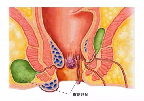 肛周脓肿的治疗,重庆康华医院肛肠外科