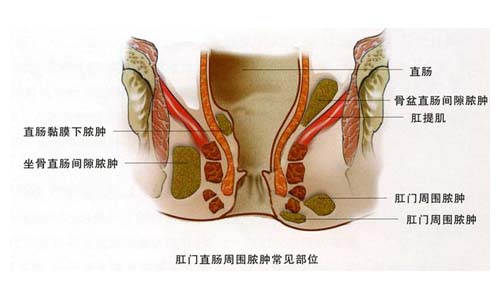 肛周脓肿的治疗,重庆康华医院肛肠外科