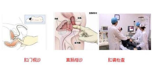 肛周脓肿的治疗,重庆康华医院肛肠外科