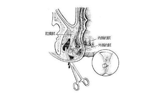 肛周脓肿的治疗,重庆康华医院肛肠外科