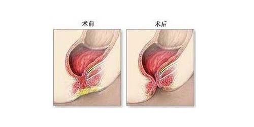 肛周脓肿的治疗,重庆康华医院肛肠外科