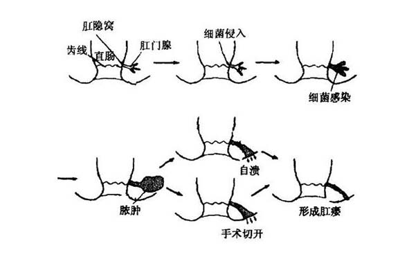 肛周脓肿的治疗,重庆康华医院肛肠外科