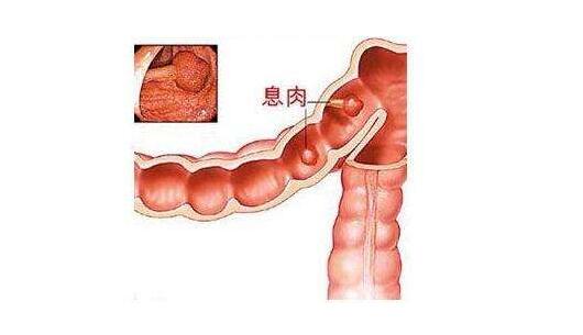 直肠息肉的诊断与治疗,重庆康华医院肛肠外科