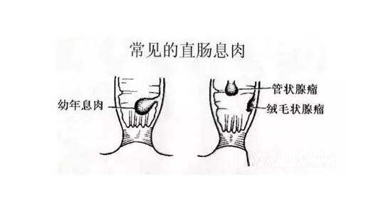 直肠息肉的治疗,重庆康华医院肛肠外科