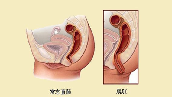 直肠息肉的治疗,重庆康华医院肛肠外科