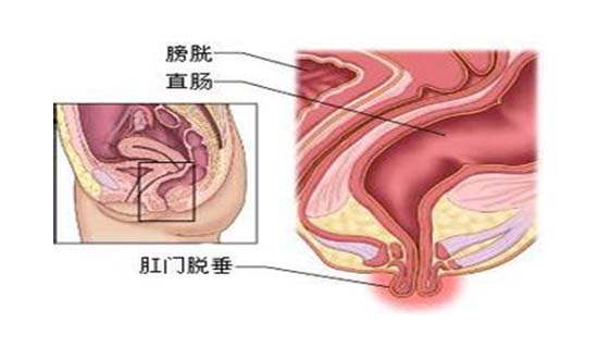 脱肛的治疗,重庆康华医院肛肠外科