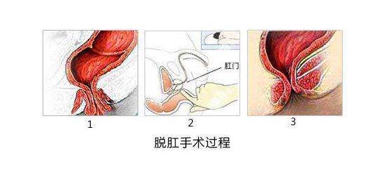 脱肛的治疗,重庆康华医院肛肠外科