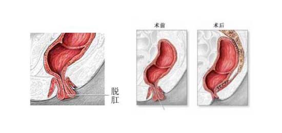 脱肛的治疗,重庆康华医院肛肠外科