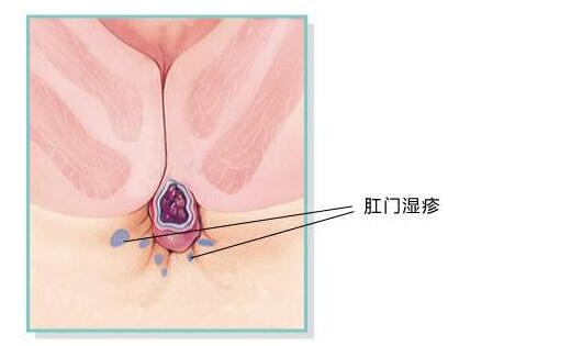 肛门湿疹的治疗,重庆康华医院肛肠外科