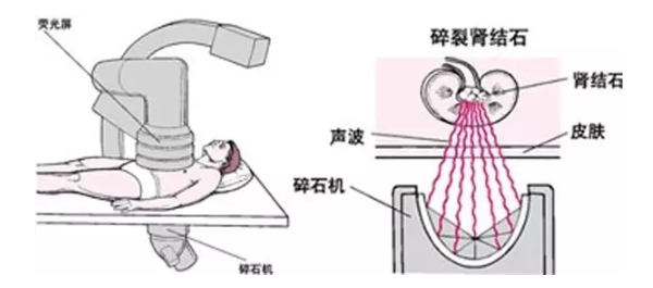 重庆康华医院,肾结石的治疗,体外冲击波碎石