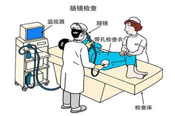 什么是肠镜检查?了解这个简单的医学常识